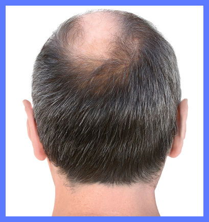 before hair transplant