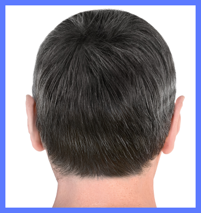 after hair transplant